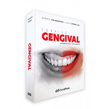 Sorriso Gengival Diagnostico e Tratamento