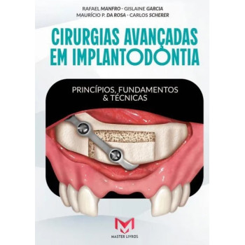 Cirurgias Avançadas Em Implantodontia - Princípios, Fundamentos e Técnicas