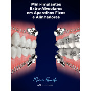 Mini -  Implantes Extra -  Alveolares Em Aparelhos Fixos E Alinhadores