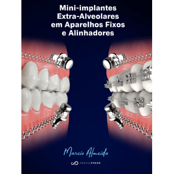 Mini -  Implantes Extra -  Alveolares Em Aparelhos Fixos E Alinhadores