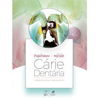Cárie Dentária: Fisiopatologia e Tratamento Cárie Dentária: Fisiopatologia e Tratamento