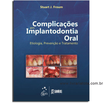 Complicações em Implantodontia Oral  - Etiologia, Prevenção e Tratamento 