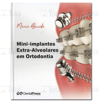 Mini-implantes Extra-Alveolares em Ortodontia Mini-implantes Extra-Alveolares em Ortodontia
