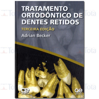 Tratamento Ortodôntico de Dentes Retidos