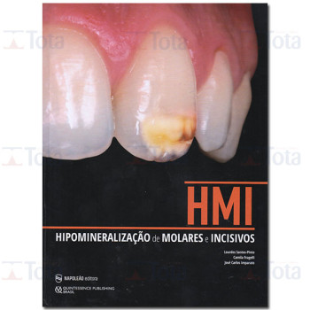 HMI - Hipomineralização de Molares e Incisivos