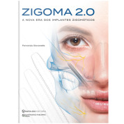 Zigoma 2.0 - A nova era dos Implantes Zigomáticos 